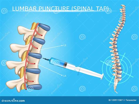 Lumbar Puncture Realistic Vector Medical Scheme Stock Vector ...