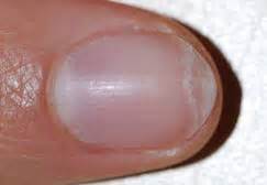 Why Are My Nails Peeling and What to Do? | MD-Health.com