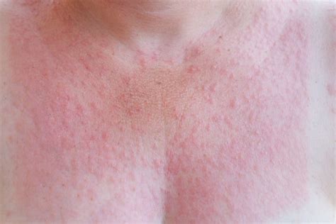 Sun Rash: What to Know About Photosensitivity - Water's Edge Dermatology