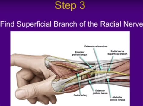 Surgery for deQuervain’s Tenosynovitis — OrthopaedicPrinciples.com