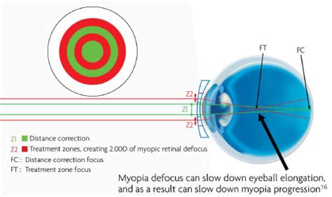 MiSight 1 Day Contact Lenses | Myopia Control Optometrist | Melbourne