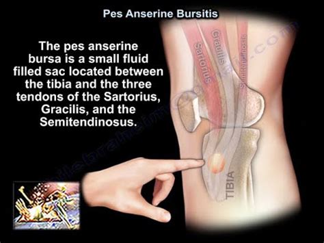 Pes anserine bursitis symptoms - jujapussy