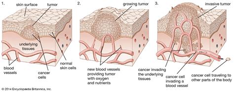 A Benign Tumor Formed by Abnormal Lymphatic Vessels - ShamarkruwFranco