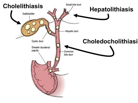 Choledocholithiasis - Stepwards