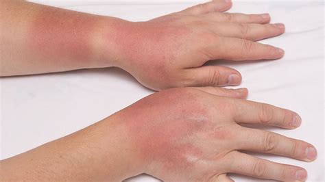 sudden red blotching on hands, elbows and chest/neck : r/AskDocs