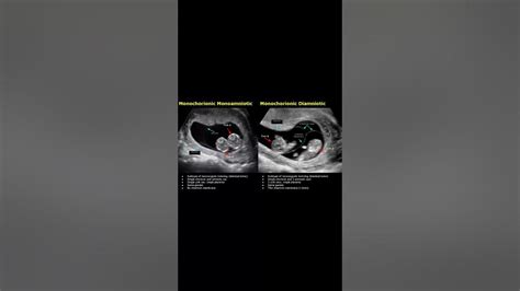 Monochorionic Monoamniotic & Monochorionic Diamniotic Twins Ultrasound ...