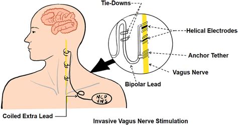 Frontiers | Research advances in the application of vagus nerve ...