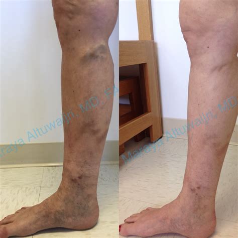 Varicose Vein Treatment | Irvine, CA | Laguna Woods, CA