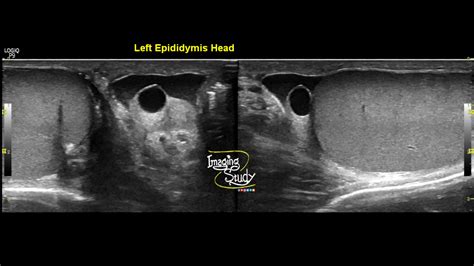 Case 24: Epididymal Cyst