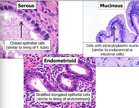 Serous Epithelial Ovarian Cancer - CancerWalls