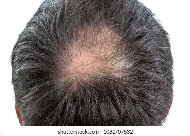 Male Head Thinning Hair Alopecia Foto de stock 1082707532 | Shutterstock