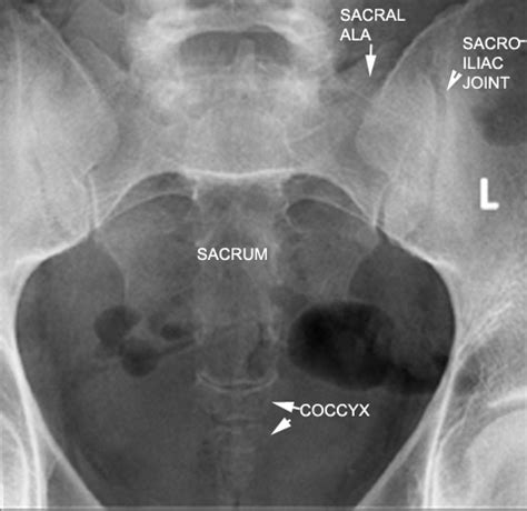 identify parts of the sacrum and coccyx click the image for labeling