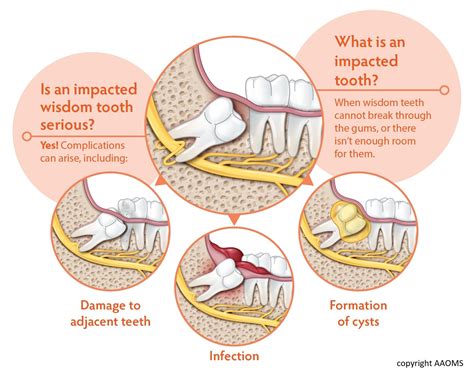 Wisdom Teeth Brea CA | Third Molars | Impacted Tooth