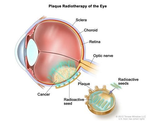 Choroidal Melanoma | What is it, Causes and Treatment