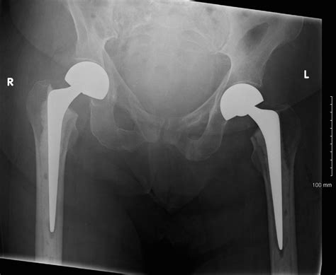 Bilateral neck of femur fractures secondary to seizure | Practical ...