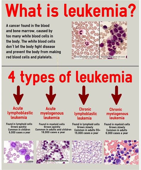 غازي العنزي☤🔬 on Twitter: "Leukemia types: 1-Acute Lymphoblastic ...