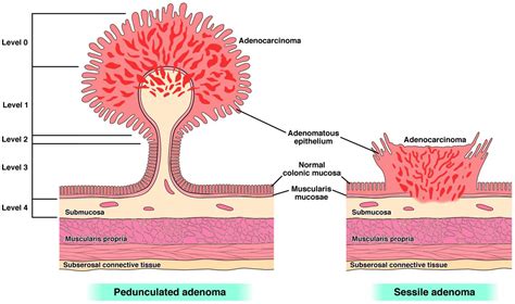 Experts release new management strategies for malignant colorectal ...