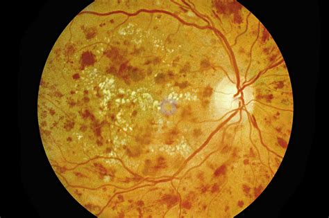 Discontinuing Treatments for Diabetic Retinopathy May Increase ...