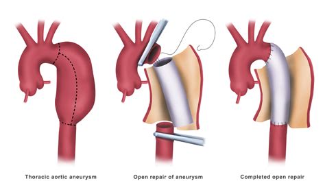 Aortic Arch To Abdominal Aorta