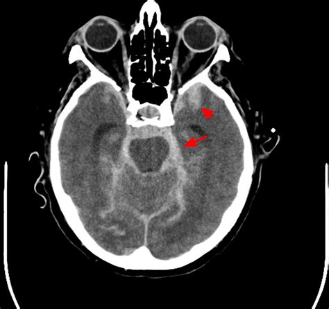 Intracranial Hemorrhage - Cause, Symptoms, Diagnosis, Treatment