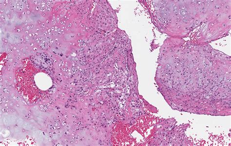 Osteosarcoma Jaw Histology