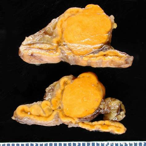 Adenoma surrenalico - sindrome di Conn - DocCheck