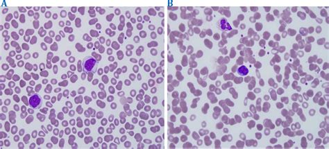 Blood smear comparing normal mononuclear lymphocytes (a) and ...