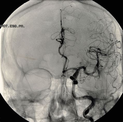 Cerebral Aneurysm | Johns Hopkins Medicine Health Library