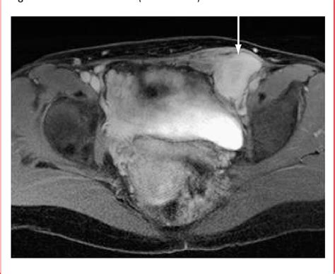 Figure 1 from A subserosal uterus-like mass presenting after a sliding ...