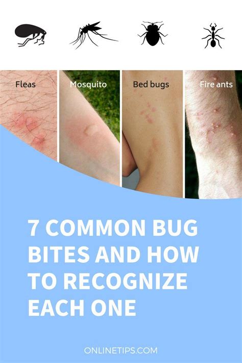 Bed bug bites vs hives – How can we tell the difference? – Go Bed Bugs ...