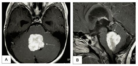 Cureus | Choroid Plexus Papilloma of the Fourth Ventricle in a ...