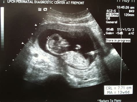 Athena's Chateau: 2nd Nuchal Translucency Ultrasound, 5/11/2011