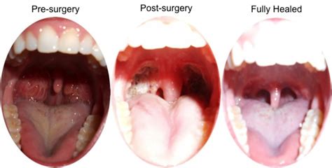 Signs And Symptoms: Does My Child Need Their Tonsils And Adenoids ...