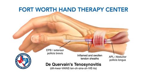 De Quervain’s Tenosynovitis