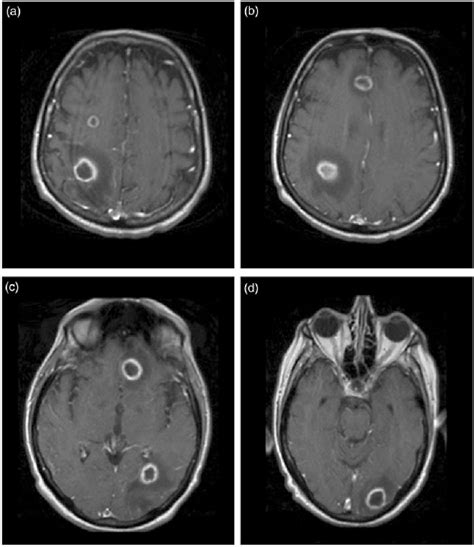 Brain Lesions Mri