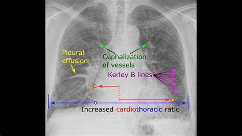 Chest X Ray in Heart failure - Dr.Rajesh Gubba - YouTube