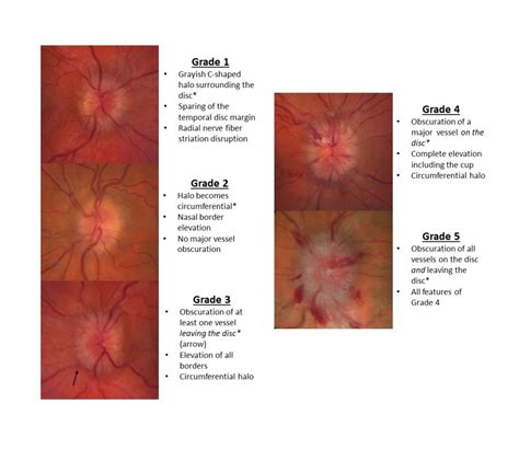 Moran CORE | Disc Edema