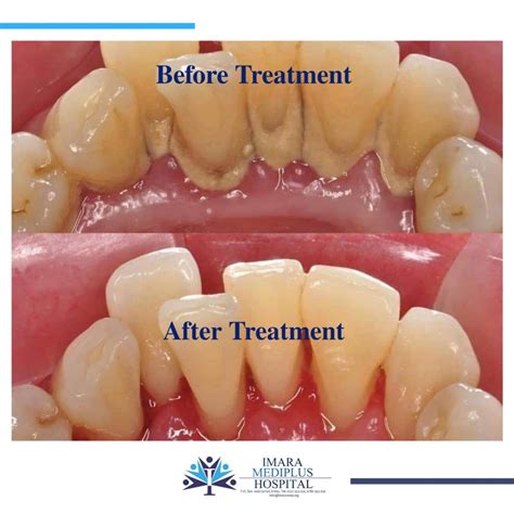 WHAT IS THE DIFFERENCE BETWEEN DENTAL CALCULUS AND PLAQUE? | Imara ...