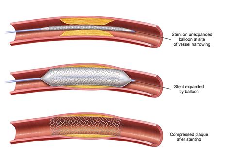 PAD Procedure Options | Azura Vascular Care