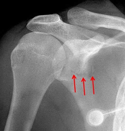 A Broken Shoulder Scapula Fracture