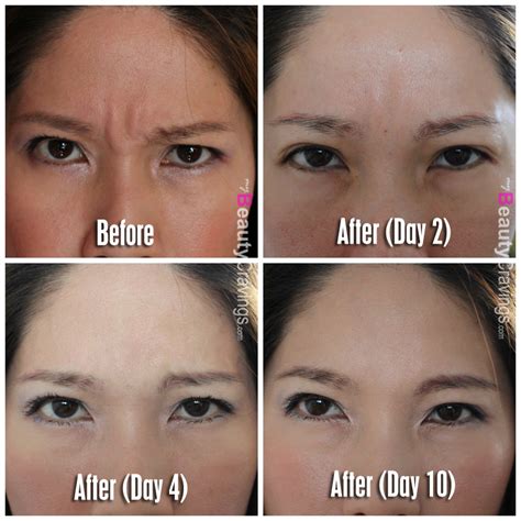 Botox Review at Cutis Medical Laser Clinics | $208 to get rid of ...