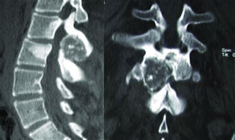 Osteoblastoma of L2. CT scan shows an expansive osteolytic lesion of ...