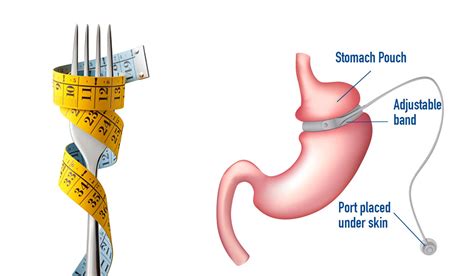 Lap Band Surgery Cost in India | Gastric Band Surgery @ Top Hospitals