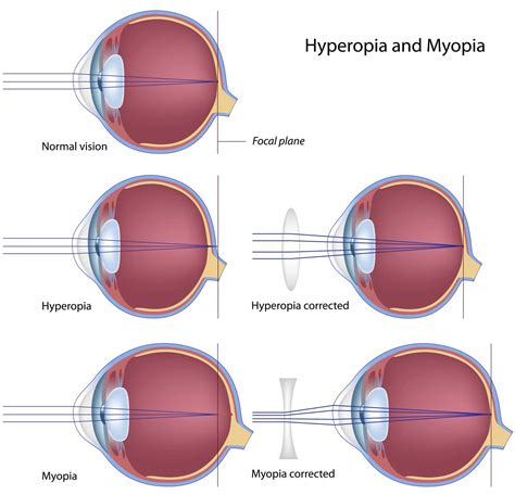 Nearsighted – Myopia – Petrou Eye Care