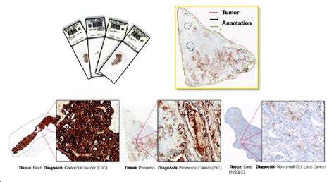 Example of tissue slides (2.5-μm FFPE) of human carcinoma tissues ...