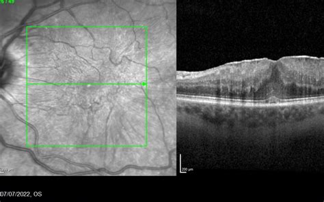 Epiretinal Membrane (ERM): Causes, Symptoms, and Treatment - Miss Anna ...