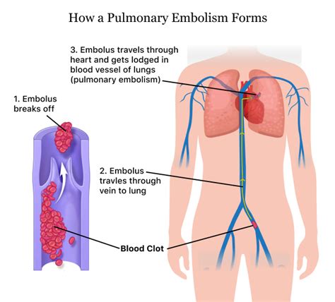 Pulmonary Embolism (PE) | Causes of a Blood Clot in the Lung