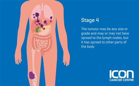 What is Soft Tissue Sarcoma? Soft Tissue Sarcoma Explained — Icon ...