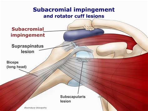 Impingement of the shoulder SHOP02 - Bloomsbury Health Centre