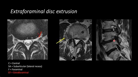 Lumbar Spine Mri Interpretation